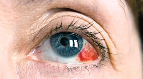 Göz Tansiyonu Ameliyatı Riskleri ve Sonrası