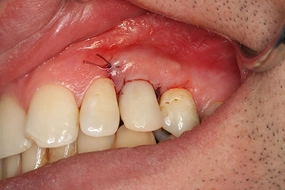 İmplant Ameliyatı Riskleri ve Sonrası