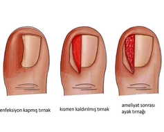 Tırnak Batması Ameliyatı Riskleri ve Sonrası