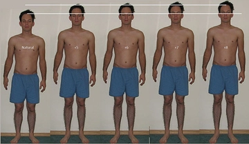 Boy Uzatma Ameliyatı Riskleri ve Sonrası